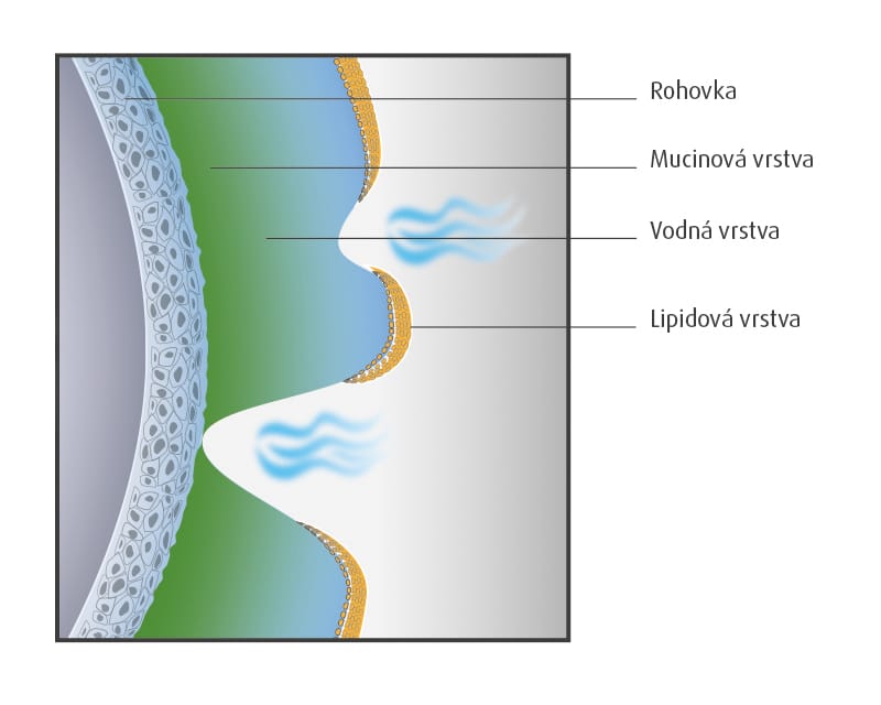 Schematické znázornění roztržení slzného filmu a hyperevaporace s tím spojené