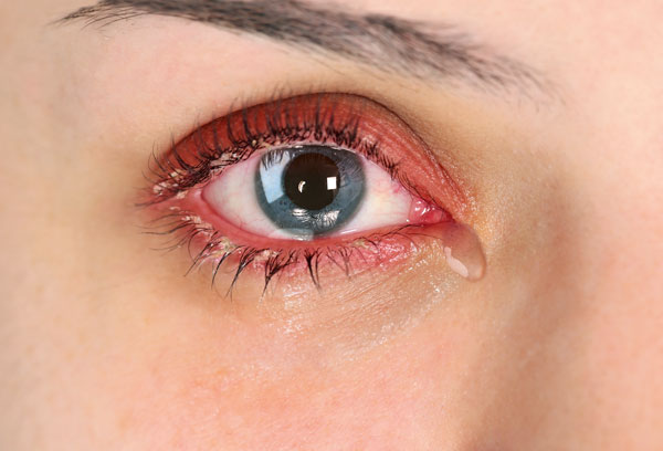 Watery eye, reddened eyes and eyelid margins, encrusted eyelids