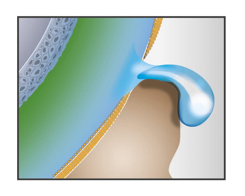 Schematic diagram of a watery eye